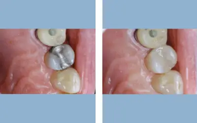 Before and After